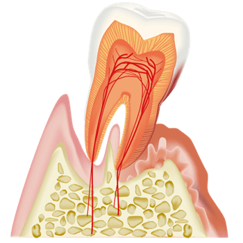 中等度から重度の歯周病