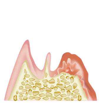 歯周病により歯が失われる